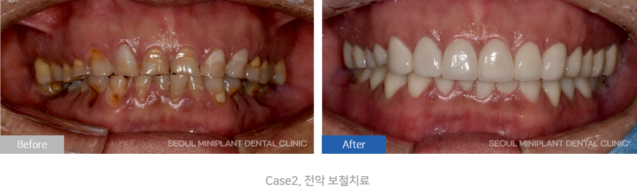 전악보철치료