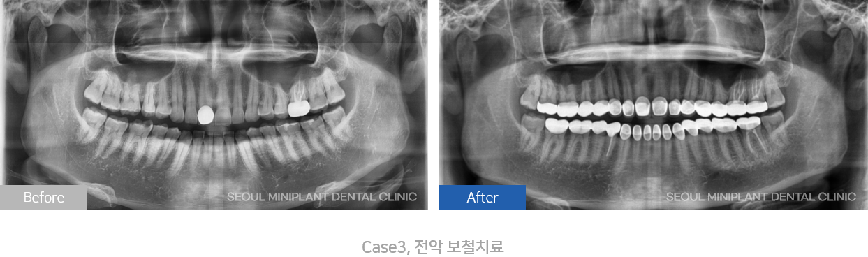 전악보철치료