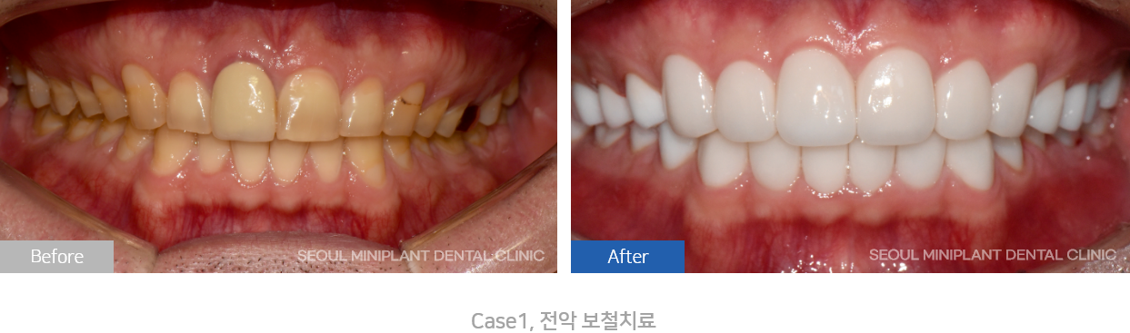 전악보철치료