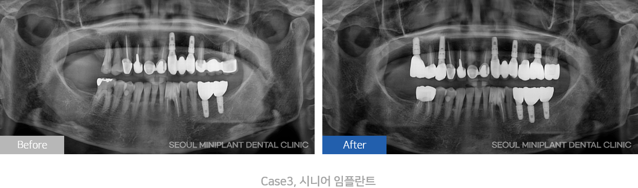 시니어치료