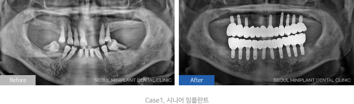 시니어치료